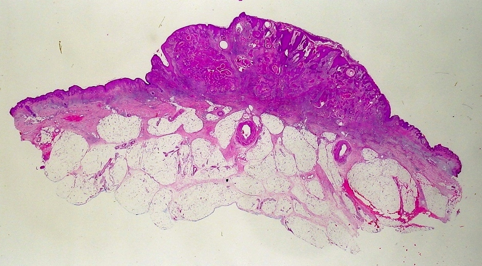 Queratoacantoma - pele. A histopatologia mostra proliferação de células escamosas que adentram para a derme. As laterais são bem demarcadas e no centro crateriforme queratina.