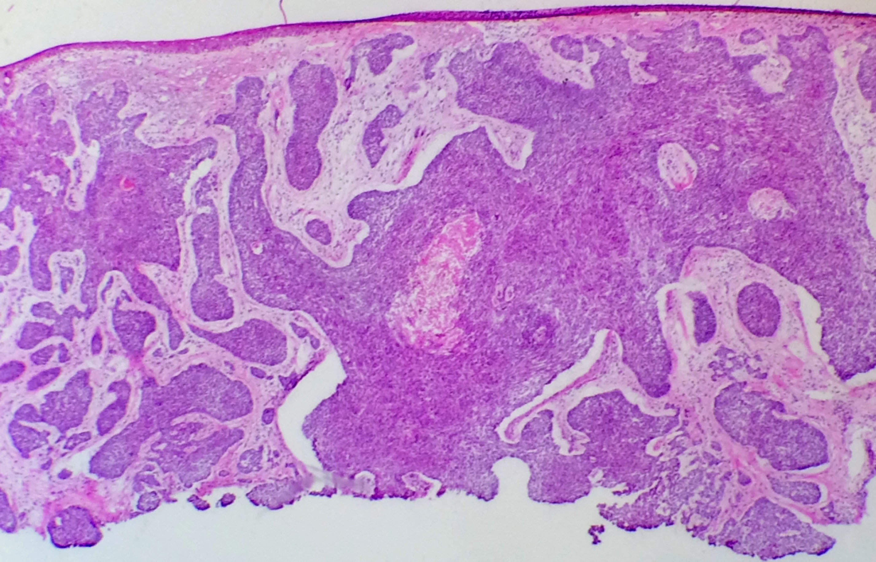 Carcinoma Basocelular em material de cirurgia micrográfica de Mohs. Debulking. Notar os blocos de células basaloides com fenda do estroma.