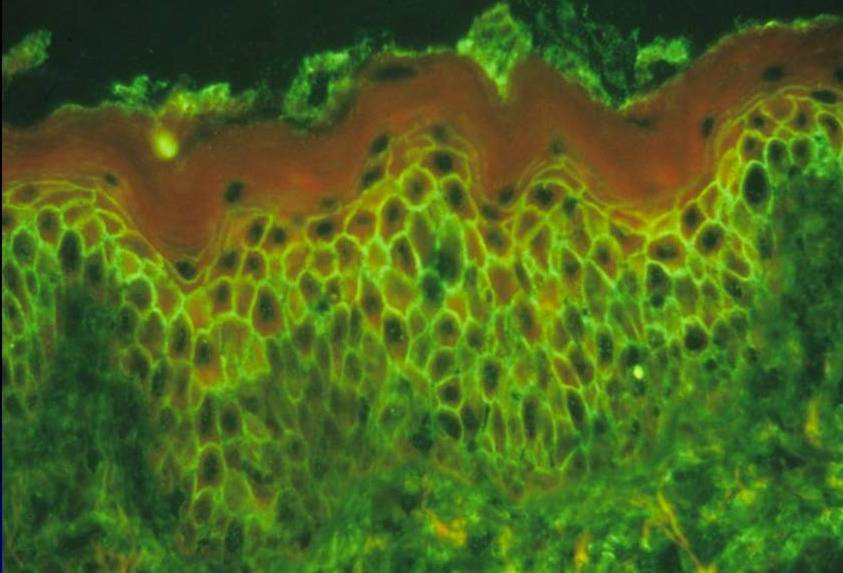 Imunofluorescência direta em biópsia de pele em caso de Pênfigo Foliáceo. Imunofluorescência positiva no espaço intercelular.